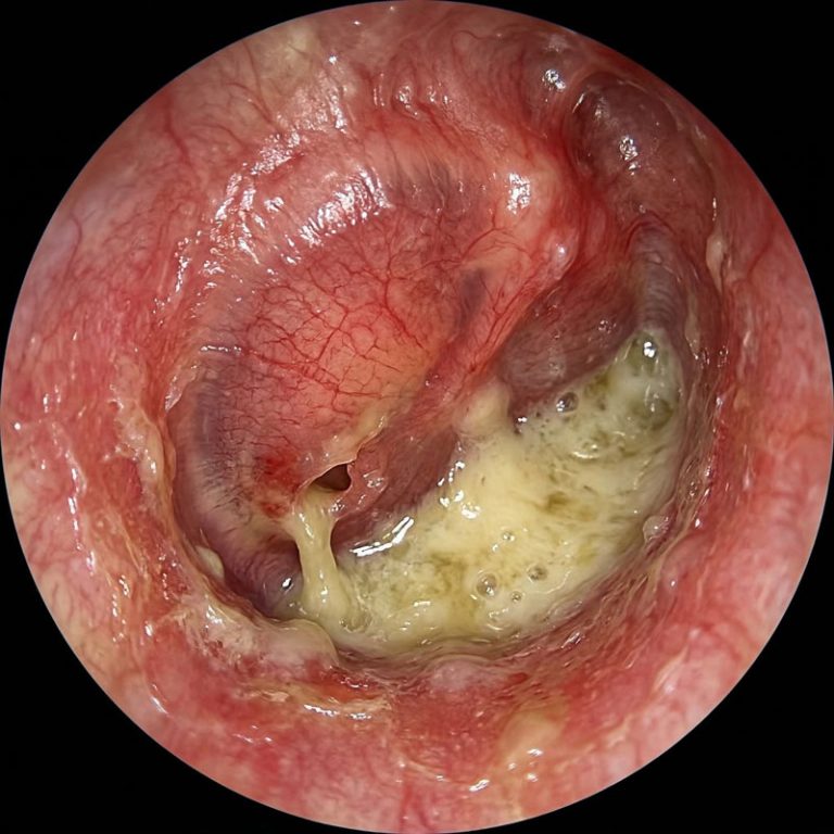 Гнойный отит