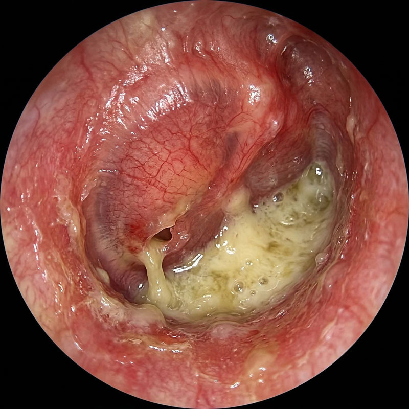 Гнойный отит